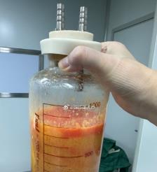 枝江水动力吸脂手术要做多久？